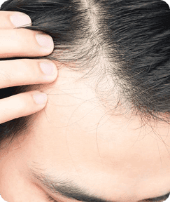 Garis rambut depan semakin mundur